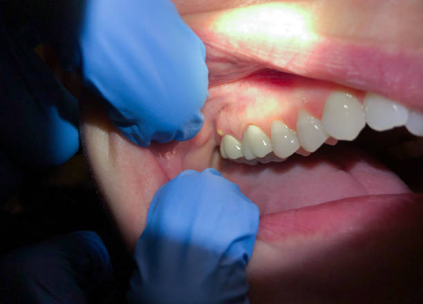 Best Emergency Gum Treatment in Hodgenville, KY